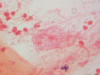 pneumonia11