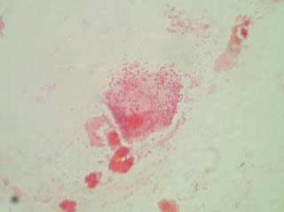 pneumonia12