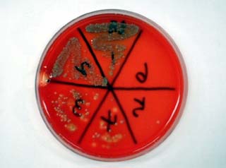 pneumonia17