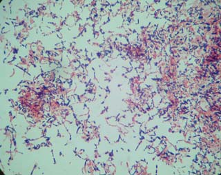 pneumonia22